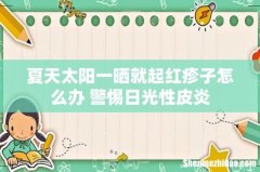 夏天太阳一晒就起红疹子怎么办 警惕日光性皮炎