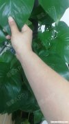 激光脱毛后多久能运动 激光脱毛后多久能运动跑步