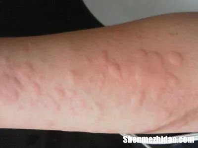 成人出疹子多久能治愈 成人出疹子多久能治愈啊