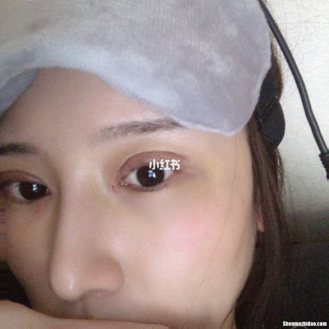 双眼皮淤青怎么办 双眼皮淤青怎么办才能消除