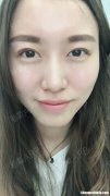双眼皮淤青怎么办 双眼皮淤青怎么办才能消除