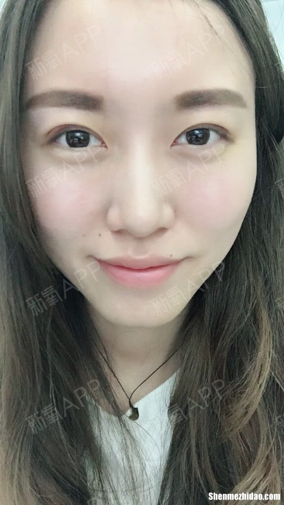 双眼皮淤青怎么办 双眼皮淤青怎么办才能消除