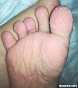脚底脱皮怎么回事 到夏天脚底脱皮怎么回事