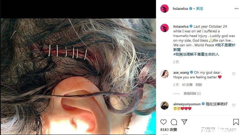 额头缝针了怎么办 额头缝针伤口多久愈合