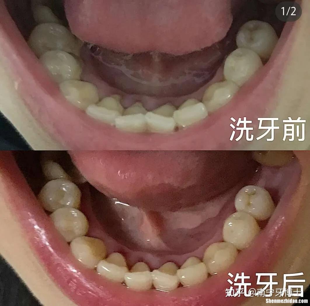 吉龈福齿南宁多少钱