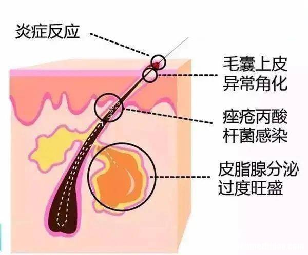 怎么样治疗青春痘 怎样才能治疗青春痘