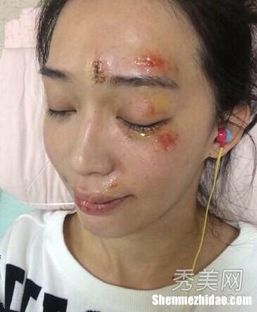 面部拆线后多久能沾水 面部拆线以后多久可以涂祛疤的药