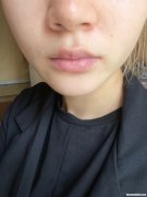 面部拆线后多久能沾水 面部拆线以后多久可以涂祛疤的药