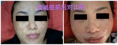 肝斑怎么去除 脸上肝斑怎么去除
