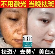 怎么去黑斑 雀斑去除的最佳方法