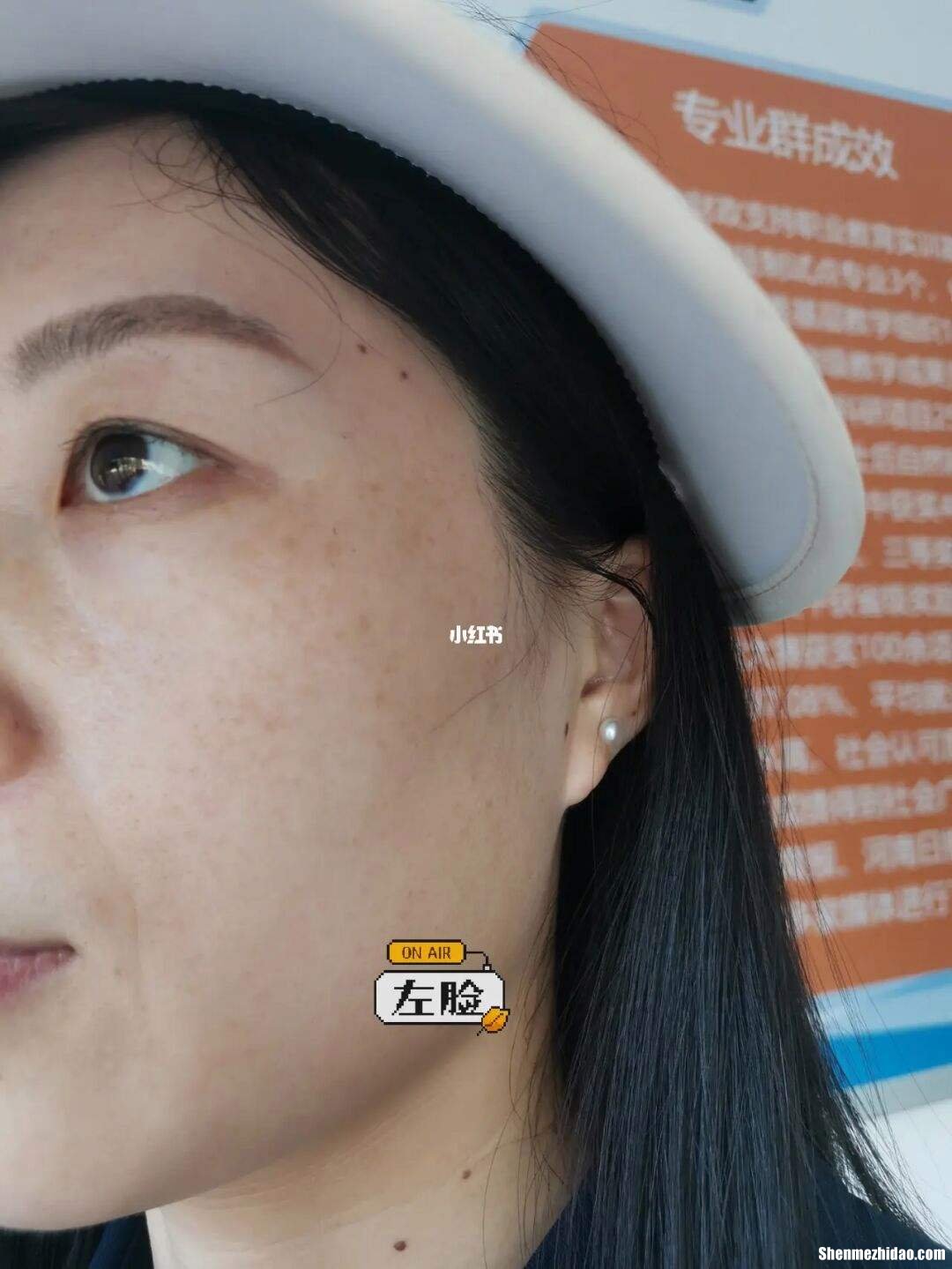 怎么去黑斑 雀斑去除的最佳方法