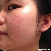 满脸青春痘怎么办 满脸青春痘怎么办,越来越严重